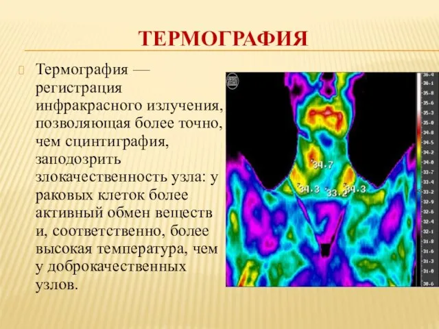 ТЕРМОГРАФИЯ Термография — регистрация инфракрасного излучения, позволяющая более точно, чем сцинтиграфия, заподозрить