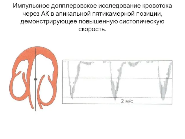 Импульсное допплеровское исследование кровотока через АК в апикальной пятикамерной позиции, демонстрирующее повышенную систолическую скорость.