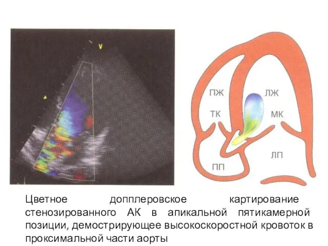 Цветное допплеровское картирование стенозированного АК в апикальной пятикамерной позиции, демострирующее высокоскоростной кровоток в проксимальной части аорты