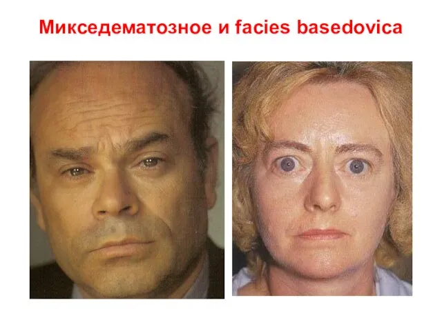 Микседематозное и facies basedovica