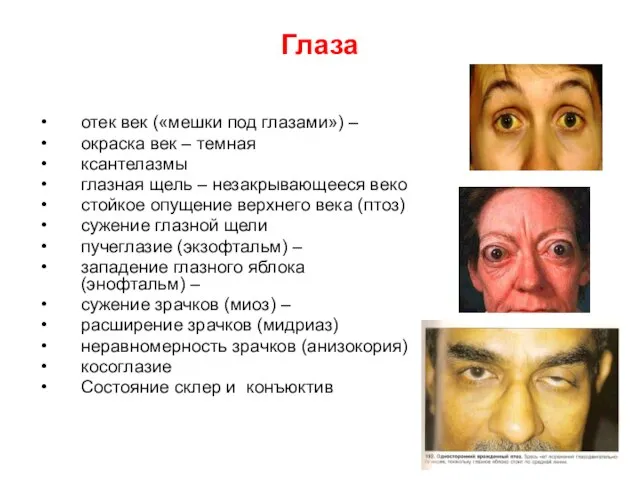 Глаза отек век («мешки под глазами») – окраска век – темная ксантелазмы