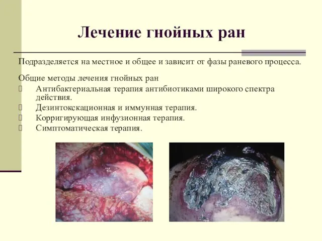 Лечение гнойных ран Подразделяется на местное и общее и зависит от фазы