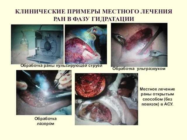 КЛИНИЧЕСКИЕ ПРИМЕРЫ МЕСТНОГО ЛЕЧЕНИЯ РАН В ФАЗУ ГИДРАТАЦИИ Обработка раны пульсирующей струей