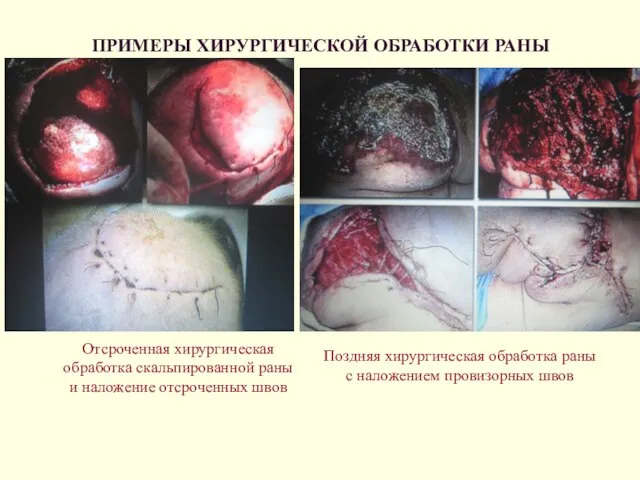 ПРИМЕРЫ ХИРУРГИЧЕСКОЙ ОБРАБОТКИ РАНЫ Отсроченная хирургическая обработка скальпированной раны и наложение отсроченных