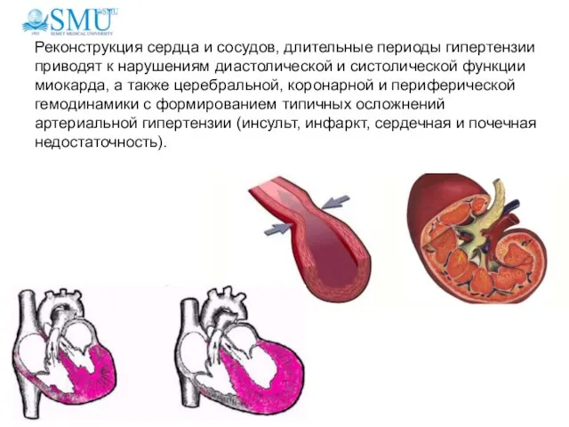 Реконструкция сердца и сосудов, длительные периоды гипертензии приводят к нарушениям диастолической и