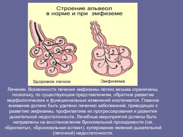 Лечение. Возможности лечения эмфиземы легких весьма ограничены, поскольку, по существующим представлениям, обратное