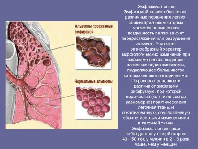 Эмфизема легких Эмфиземой легких обозначают различные поражения легких, общим признаком которых является
