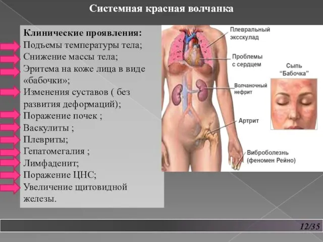 12/35 Системная красная волчанка Клинические проявления: Подъемы температуры тела; Снижение массы тела;