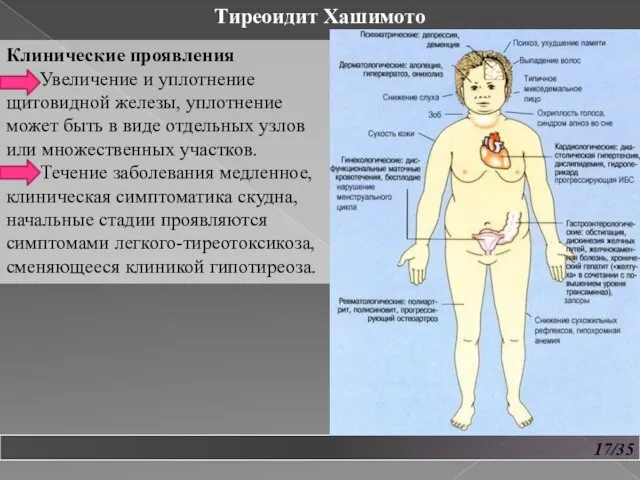 17/35 Тиреоидит Хашимото Клинические проявления Увеличение и уплотнение щитовидной железы, уплотнение может