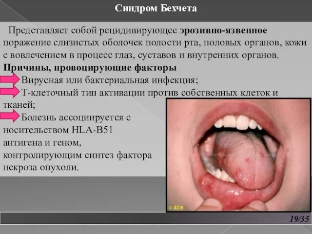 19/35 Синдром Бехчета Представляет собой рецидивирующее эрозивно-язвенное поражение слизистых оболочек полости рта,