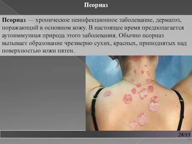 28/35 Псориаз Псориаз — хроническое неинфекционное заболевание, дерматоз, поражающий в основном кожу.