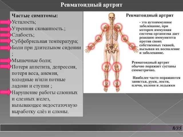 8/35 Ревматоидный артрит Частые симптомы: Усталость; Утренняя скованность.; Слабость; Субфебрильная температура; Боли