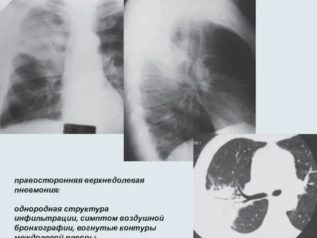 правосторонняя верхнедолевая пневмония: однородная структура инфильтрации, симптом воздушной бронхографии, вогнутые контуры междолевой плевры