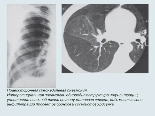 Правосторонняя среднедолевая пневмония. Интерстициальная пневмония: однородная структура инфильтрации, уплотнение легочной ткани по