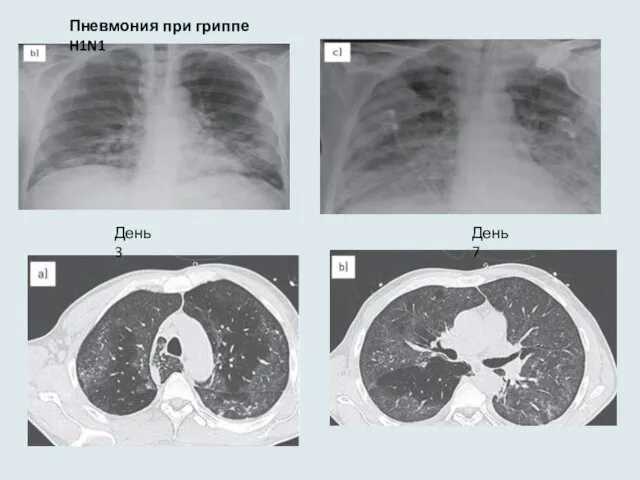 Пневмония при гриппе H1N1 День 3 День 7