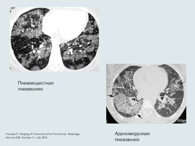 Пневмоцистная пневмония Аденовирусная пневмония FranquetT. Imaging of Pulmonary Viral Pneumonia. Radiology: Volume 260: Number 1—July 2011