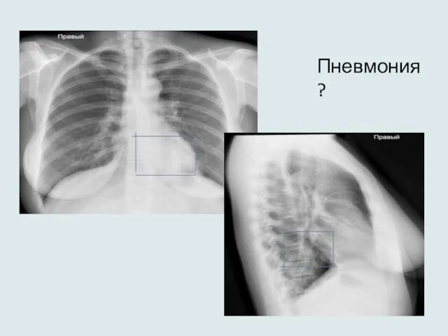 Пневмония ?