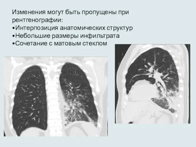 Изменения могут быть пропущены при рентгенографии: •Интерпозиция анатомических структур •Небольшие размеры инфильтрата •Сочетание с матовым стеклом