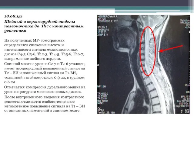 шейного лордоза 18.08.15г Шейный и верхнегрудной отделы позвоночника до Th7 с контрастным