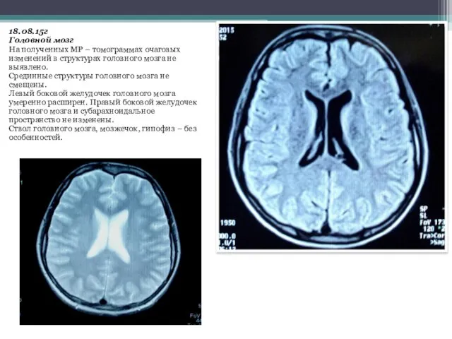 18.08.15г Головной мозг На полученных МР – томограммах очаговых изменений в структурах