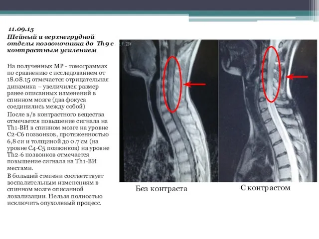 11.09.15 Шейный и верхнегрудной отделы позвоночника до Th9 с контрастным усилением На