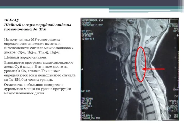 10.12.15 Шейный и верхнегрудной отделы позвоночника до Th6 На полученных МР-томограммах определяется