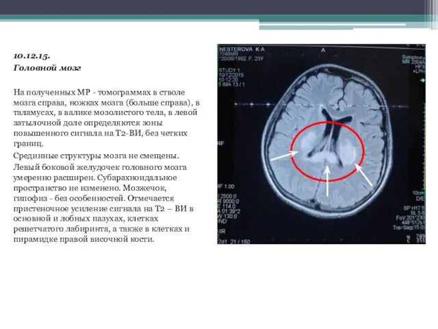 10.12.15. Головной мозг На полученных МР - томограммах в стволе мозга справа,