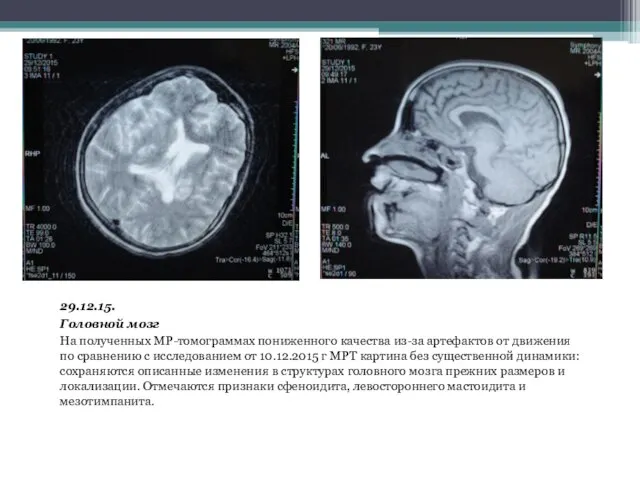 29.12.15. Головной мозг На полученных МР-томограммах пониженного качества из-за артефактов от движения