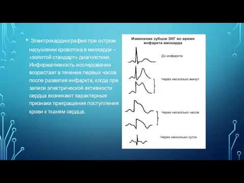 Электрокардиография при остром нарушении кровотока в миокарде – «золотой стандарт» диагностики. Информативность