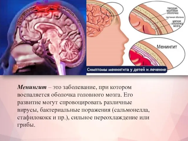 Менингит – это заболевание, при котором воспаляется оболочка головного мозга. Его развитие