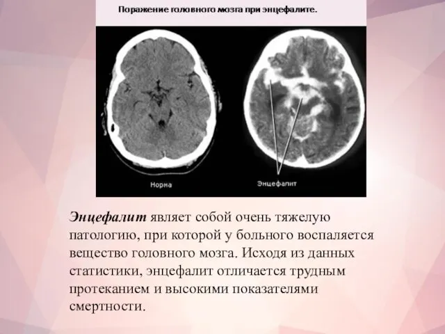 Энцефалит являет собой очень тяжелую патологию, при которой у больного воспаляется вещество