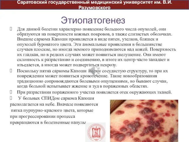 Этиопатогенез Для данной болезни характерно появление большого числа опухолей, они образуются на