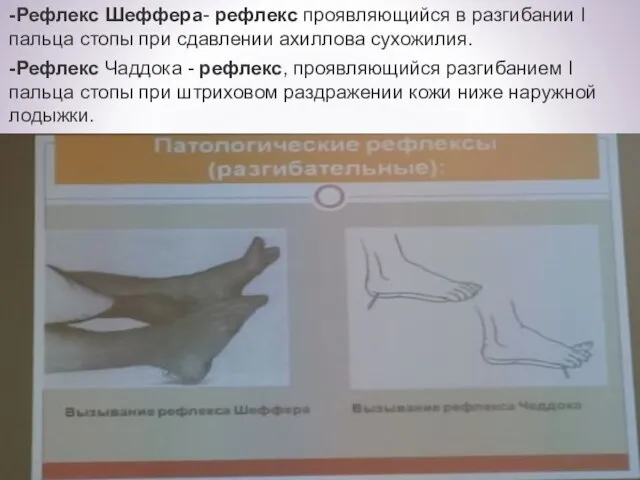 -Рефлекс Шеффера- рефлекс проявляющийся в разгибании I пальца стопы при сдавлении ахиллова