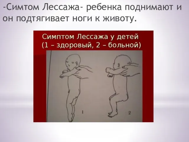 -Симтом Лессажа- ребенка поднимают и он подтягивает ноги к животу.