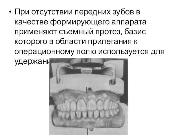 При отсутствии передних зубов в качестве формирующего аппарата применяют съемный протез, базис