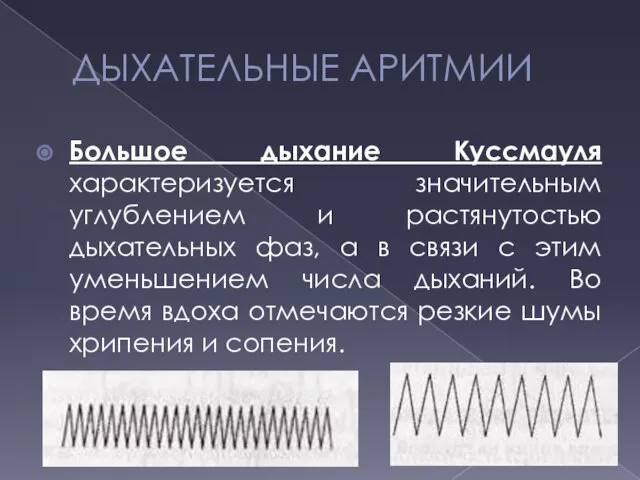 ДЫХАТЕЛЬНЫЕ АРИТМИИ Большое дыхание Куссмауля характеризуется значительным углублением и растянутостью дыхательных фаз,