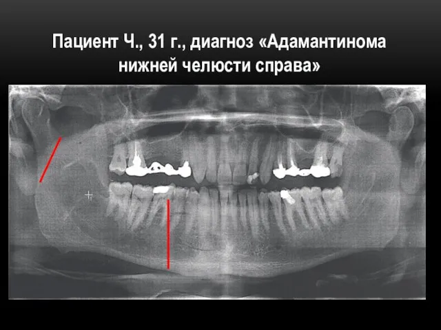 Пациент Ч., 31 г., диагноз «Адамантинома нижней челюсти справа»