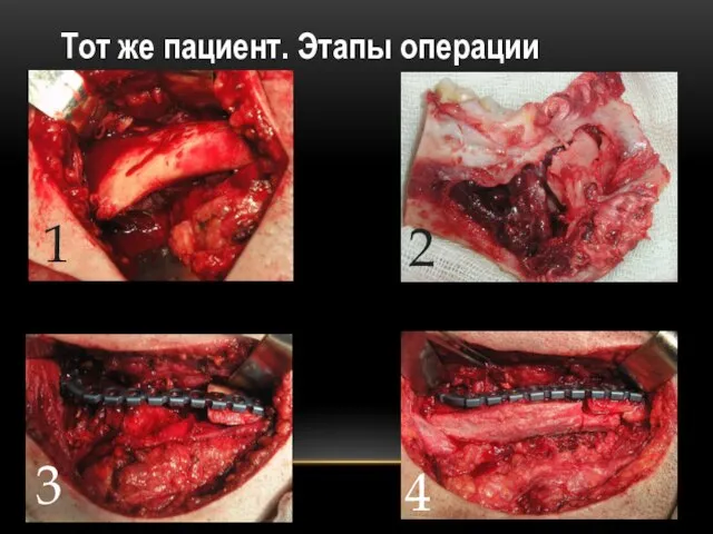 Тот же пациент. Этапы операции 1 2 3 4