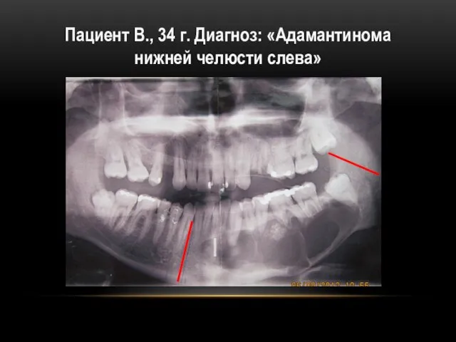 Пациент В., 34 г. Диагноз: «Адамантинома нижней челюсти слева»