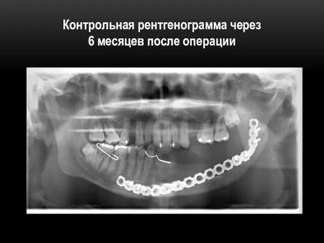 Контрольная рентгенограмма через 6 месяцев после операции