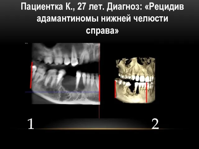 Пациентка К., 27 лет. Диагноз: «Рецидив адамантиномы нижней челюсти справа» 1 2