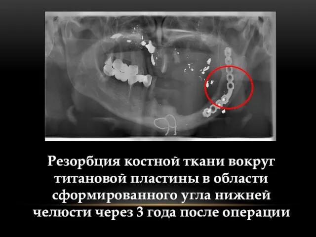 Резорбция костной ткани вокруг титановой пластины в области сформированного угла нижней челюсти