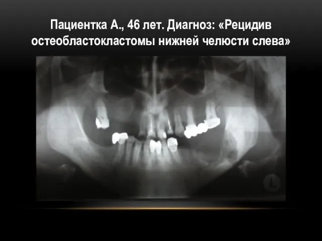 Пациентка А., 46 лет. Диагноз: «Рецидив остеобластокластомы нижней челюсти слева»