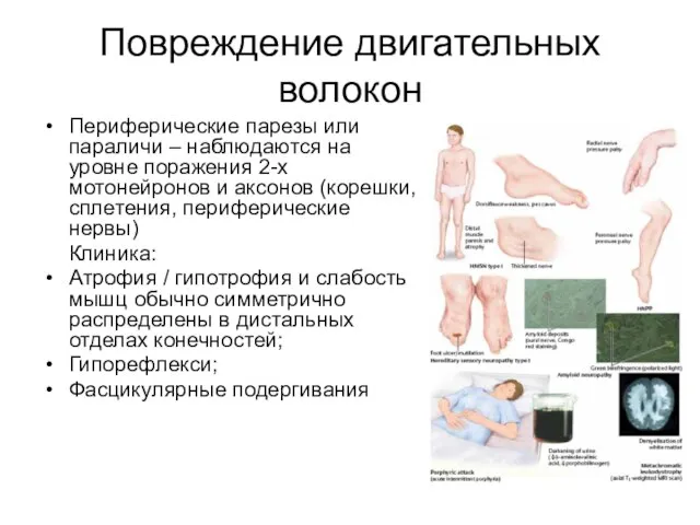 Повреждение двигательных волокон Периферические парезы или параличи – наблюдаются на уровне поражения