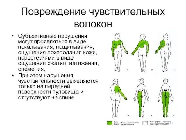 Повреждение чувствительных волокон Субъективные нарушения могут проявляться в виде покалывания, пощипывания, ощущения