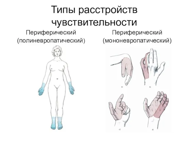 Типы расстройств чувствительности Периферический (полиневропатический) Периферический (мононевропатический)