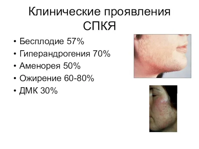 Клинические проявления СПКЯ Бесплодие 57% Гиперандрогения 70% Аменорея 50% Ожирение 60-80% ДМК 30%