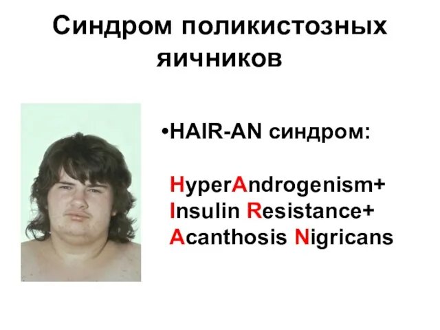 Синдром поликистозных яичников HAIR-AN синдром: HyperAndrogenism+ Insulin Resistance+ Acanthosis Nigricans