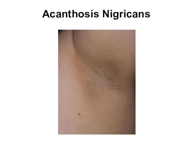 Acanthosis Nigricans