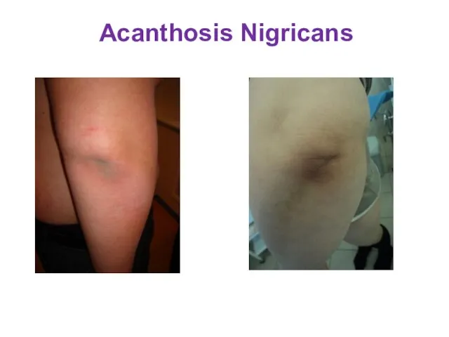 Acanthosis Nigricans